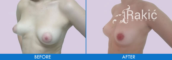 Tubular breasts – breast lift